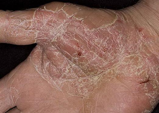 Cómo curar el eczema en las manos?