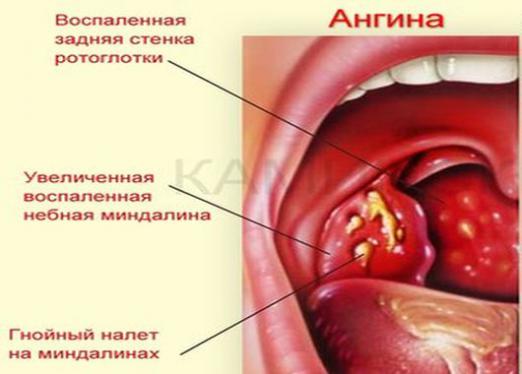 ¿Qué es angina?