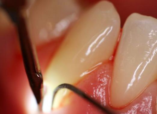 ¿Qué es la enfermedad periodontal?